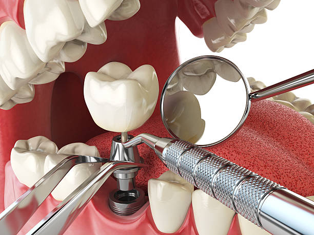 Best Emergency Root Canal Treatment in San Carlos Park, FL