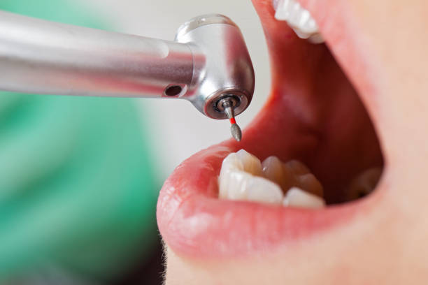 Best Emergency Root Canal Treatment in San Carlos Park, FL